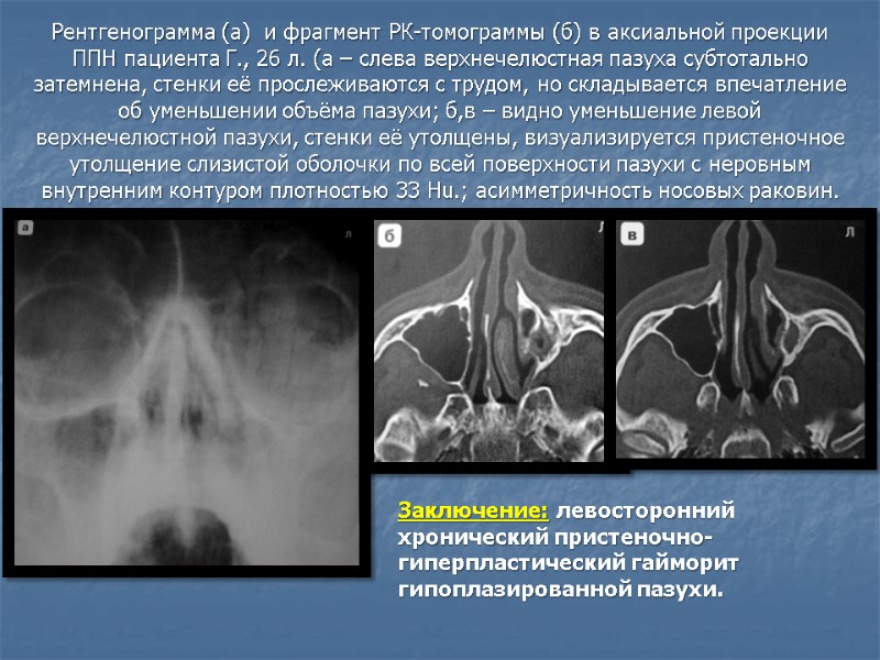 Рентгенограмма (а)  и фрагмент РК-томограммы (б) в аксиальной проекции ППН пациента Г., 26